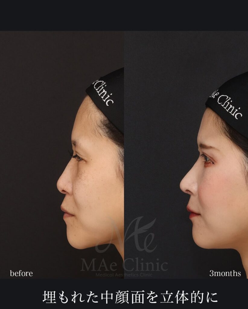 鼻中隔延長（肋軟骨） 鼻尖形成 鼻尖軟骨移植 猫貴族手術（肋軟骨） 望月正人医師症例