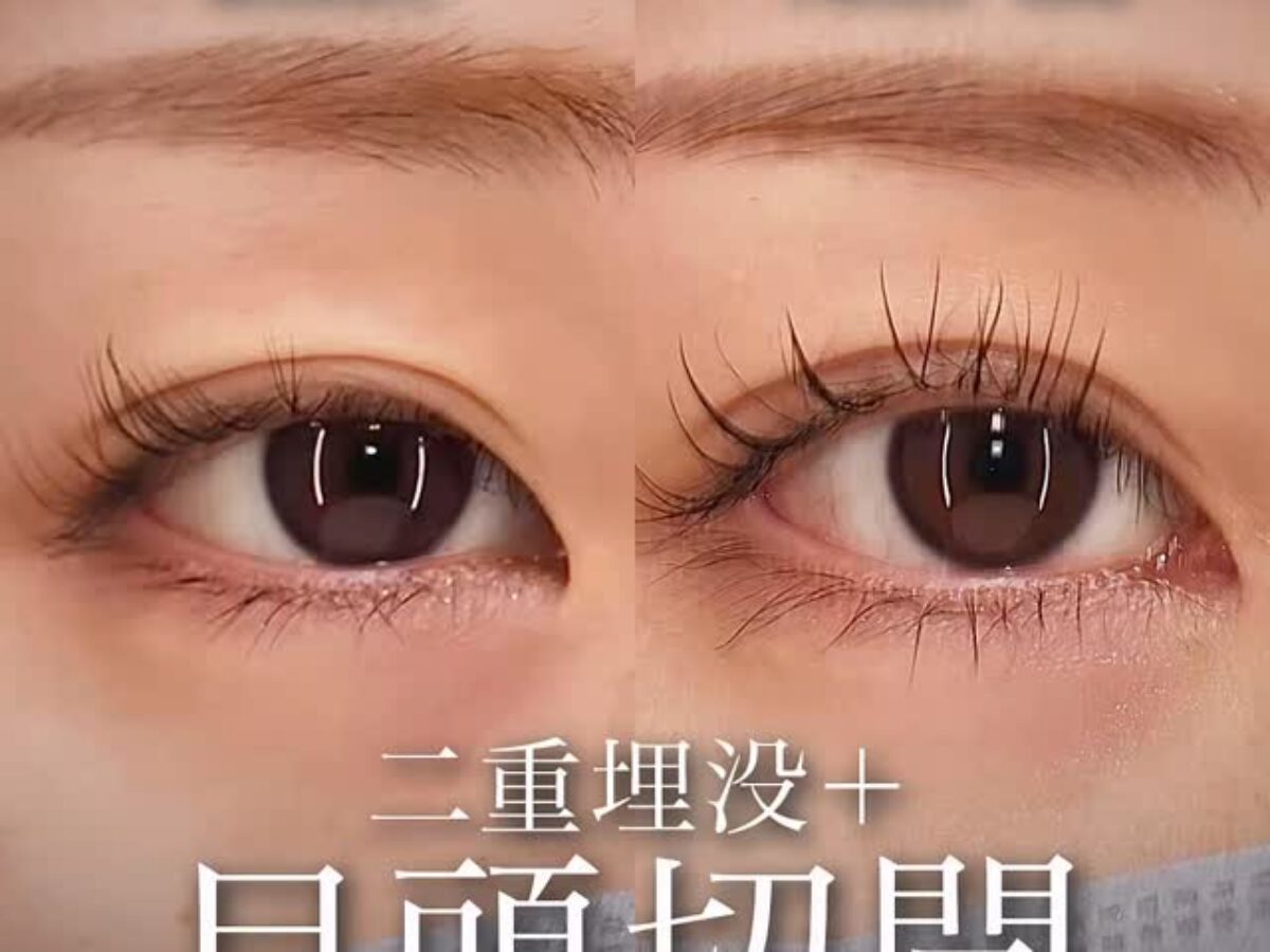 離れ目をZ法で整えてMix二重に仕上げた前之園健太医師の目頭切開症例