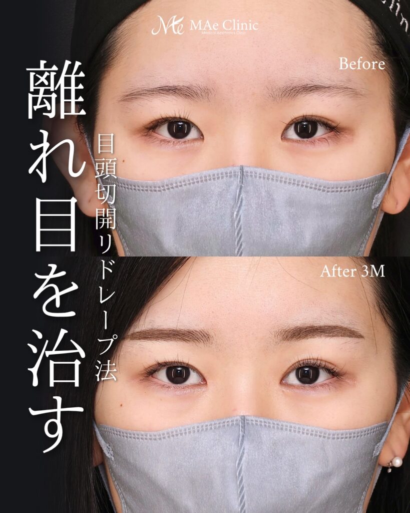 目頭切開（リドレープ法）前之園健太医師症例