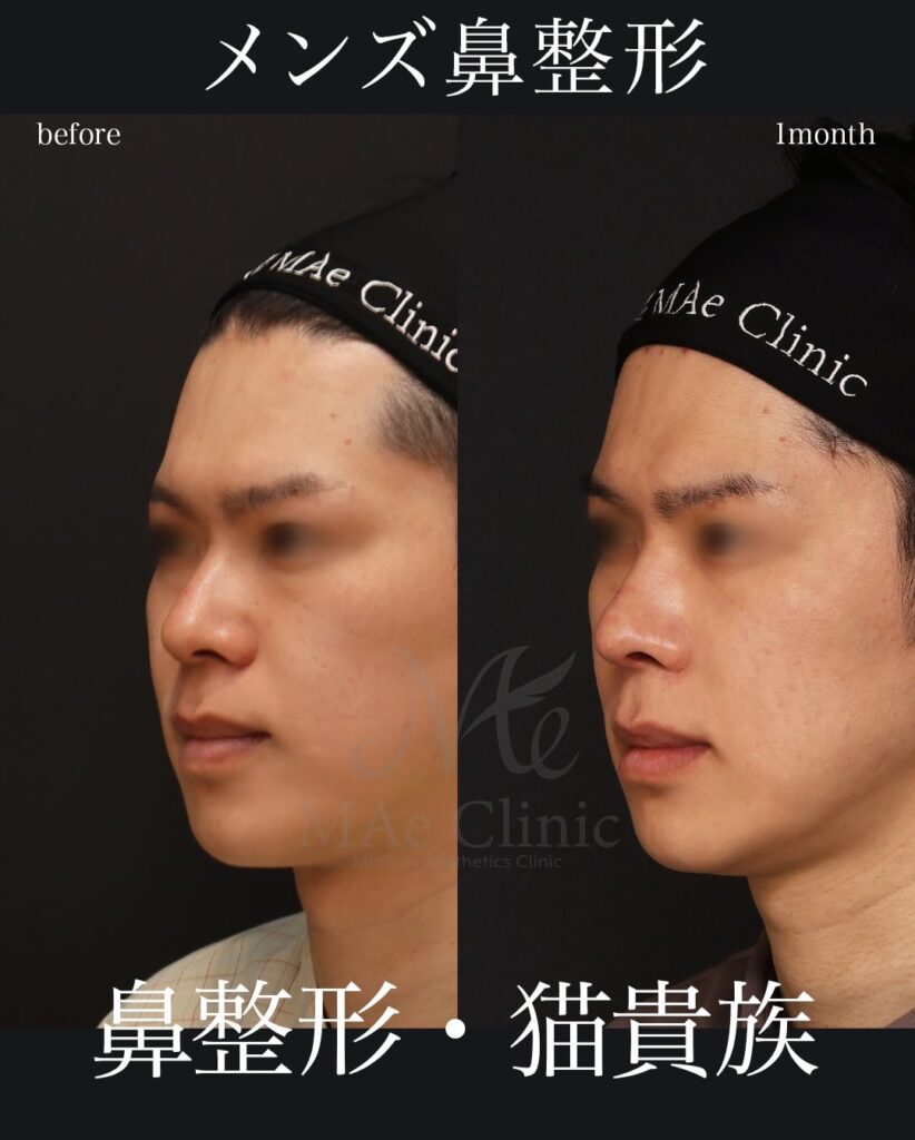 鼻中隔延長（肋軟骨）
鼻尖形成
鼻尖軟骨移植
猫貴族手術（肋軟骨）
※貴族部位ヒアルロン酸溶解後に肋軟骨へ置き換え
望月正人医師症例