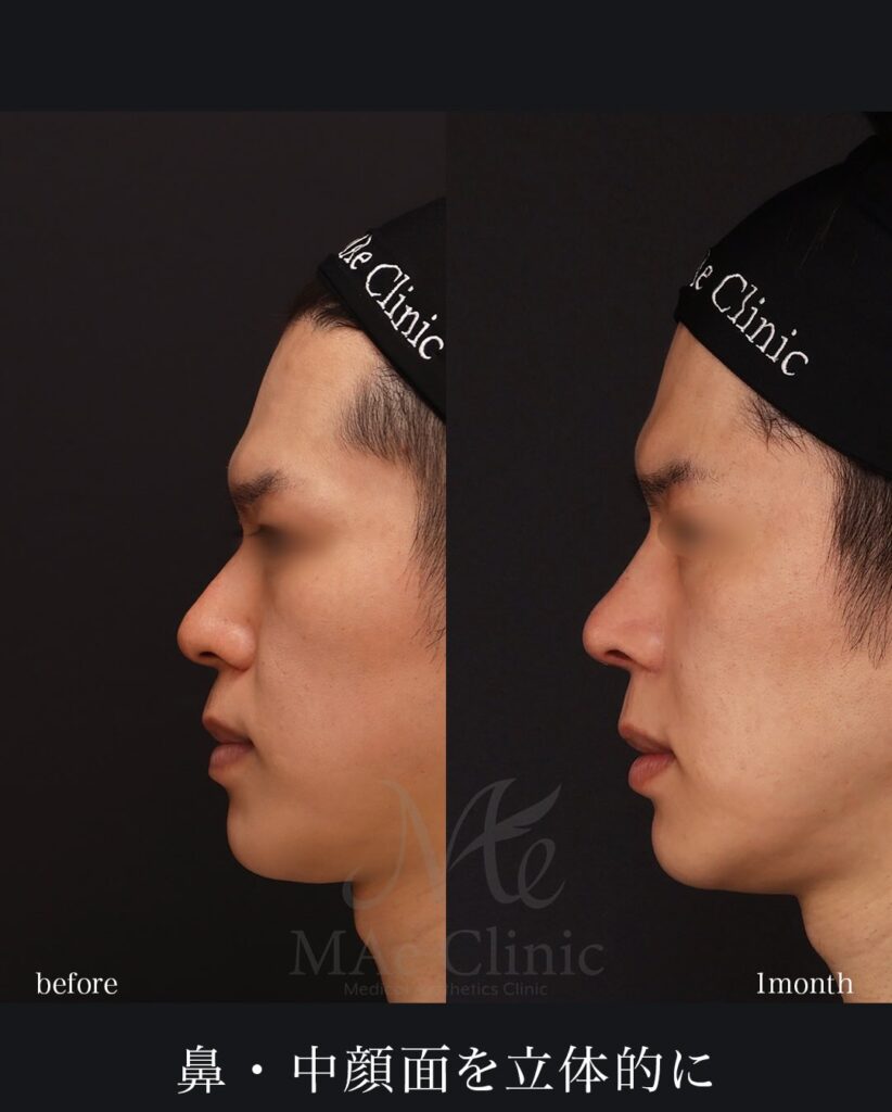 鼻中隔延長（肋軟骨） 鼻尖形成 鼻尖軟骨移植 猫貴族手術（肋軟骨） ※貴族部位ヒアルロン酸溶解後に肋軟骨へ置き換え 望月正人医師症例