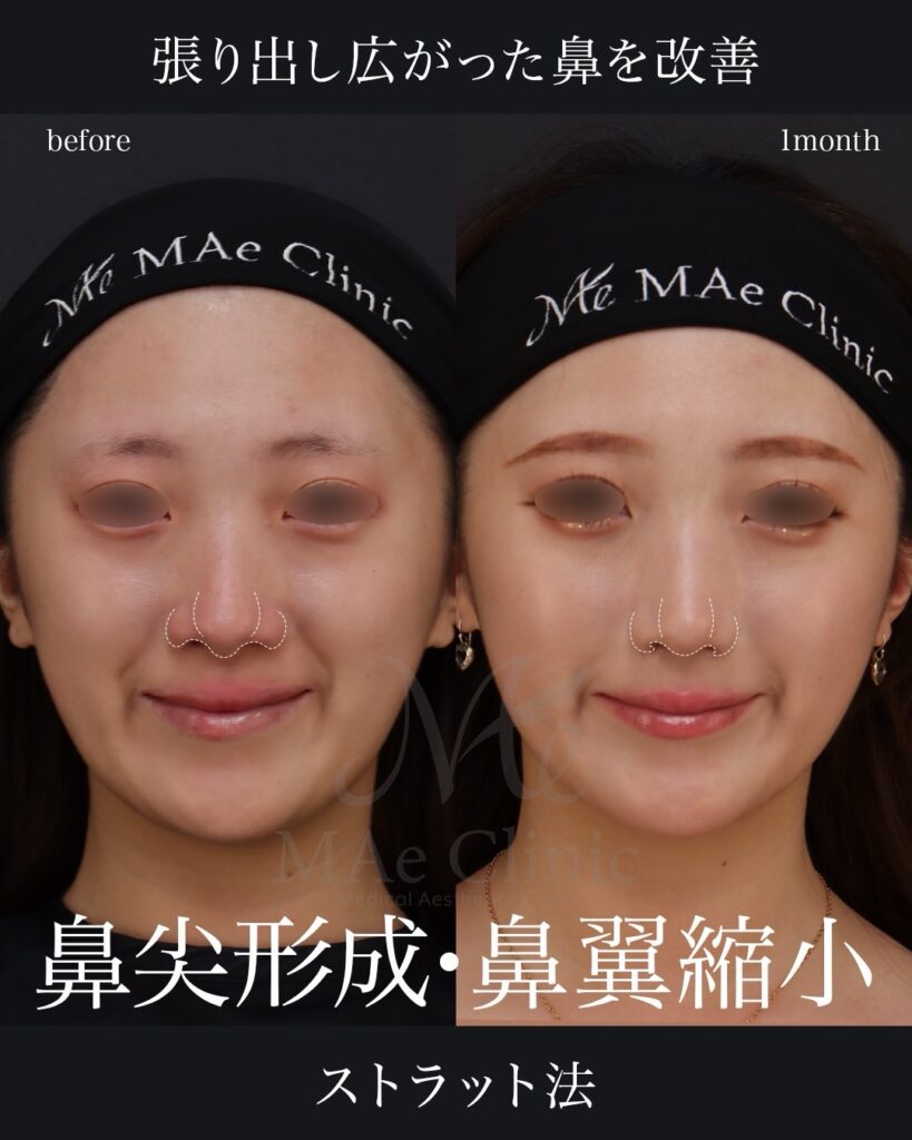 鼻尖形成
鼻尖軟骨移植
ストラット法
鼻翼縮小（内側法）
前田翔医師症例