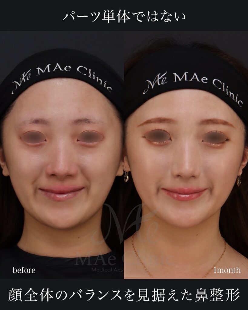 鼻尖形成 鼻尖軟骨移植 ストラット法 鼻翼縮小（内側法） 前田翔医師症例