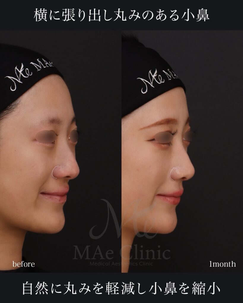 鼻尖形成 鼻尖軟骨移植 ストラット法 鼻翼縮小（内側法） 前田翔医師症例