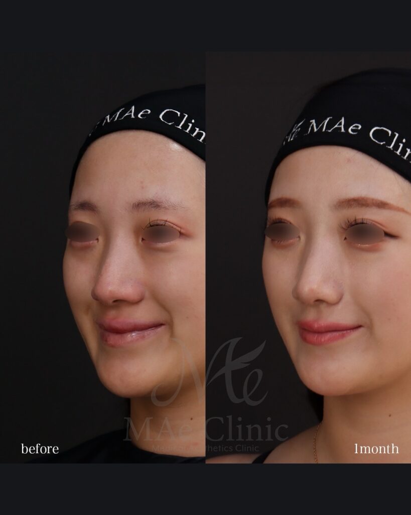 鼻尖形成 鼻尖軟骨移植 ストラット法 鼻翼縮小（内側法） 前田翔医師症例