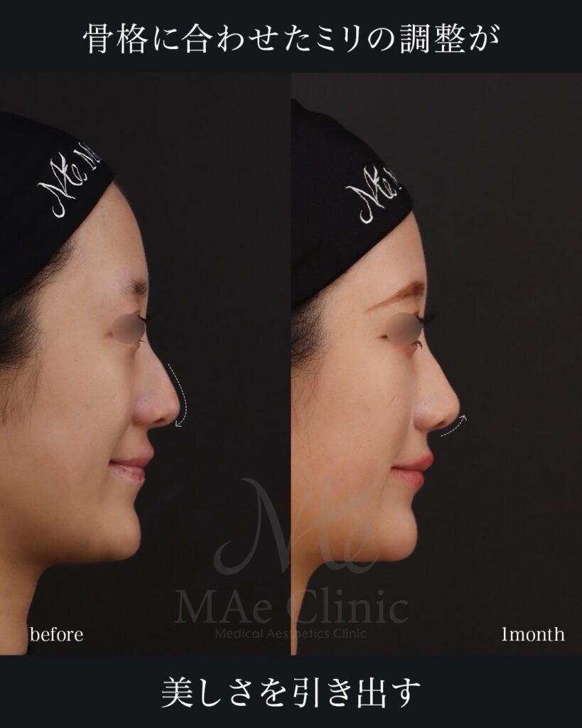 鼻尖形成 鼻尖軟骨移植 ストラット法 鼻翼縮小（内側法） 前田翔医師症例