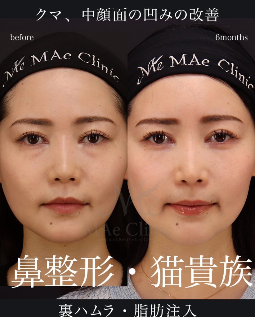 鼻中隔延長（肋軟骨） 鼻尖形成 鼻尖軟骨移植 猫貴族手術（肋軟骨） 隆鼻 額脂肪注入 裏ハムラ法 望月正人医師症例