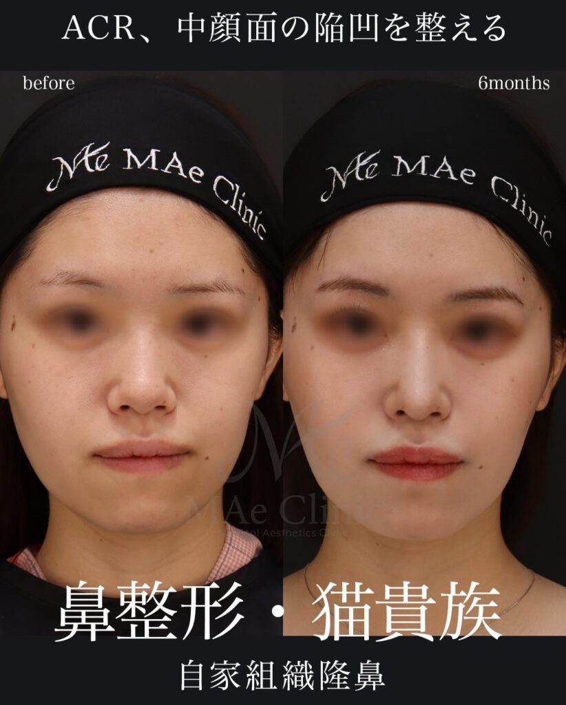 鼻中隔延長（肋軟骨） 鼻尖形成 鼻尖軟骨移植 猫貴族手術（肋軟骨） 望月正人医師症例