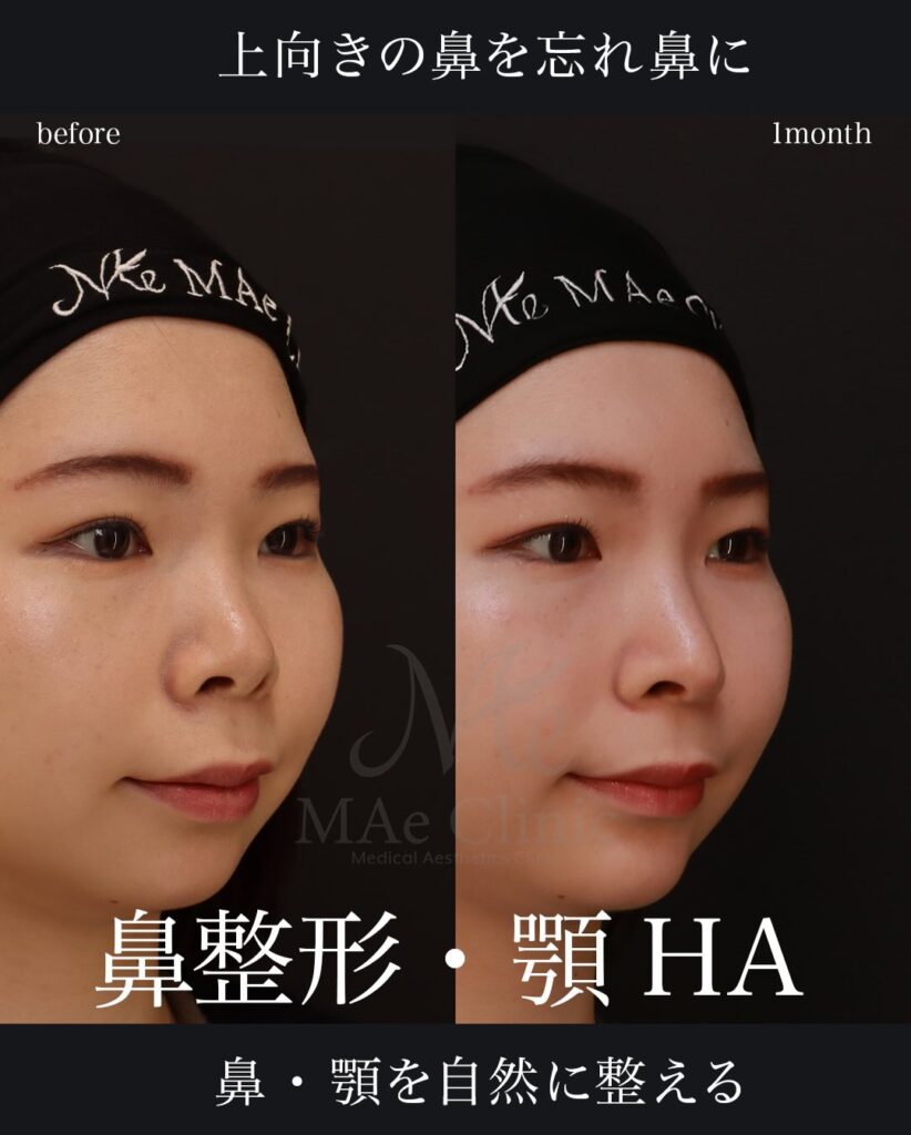 鼻中隔延長（肋軟骨） 鼻尖形成 鼻尖軟骨移植 顎ヒアルロン酸 望月正人医師症例
