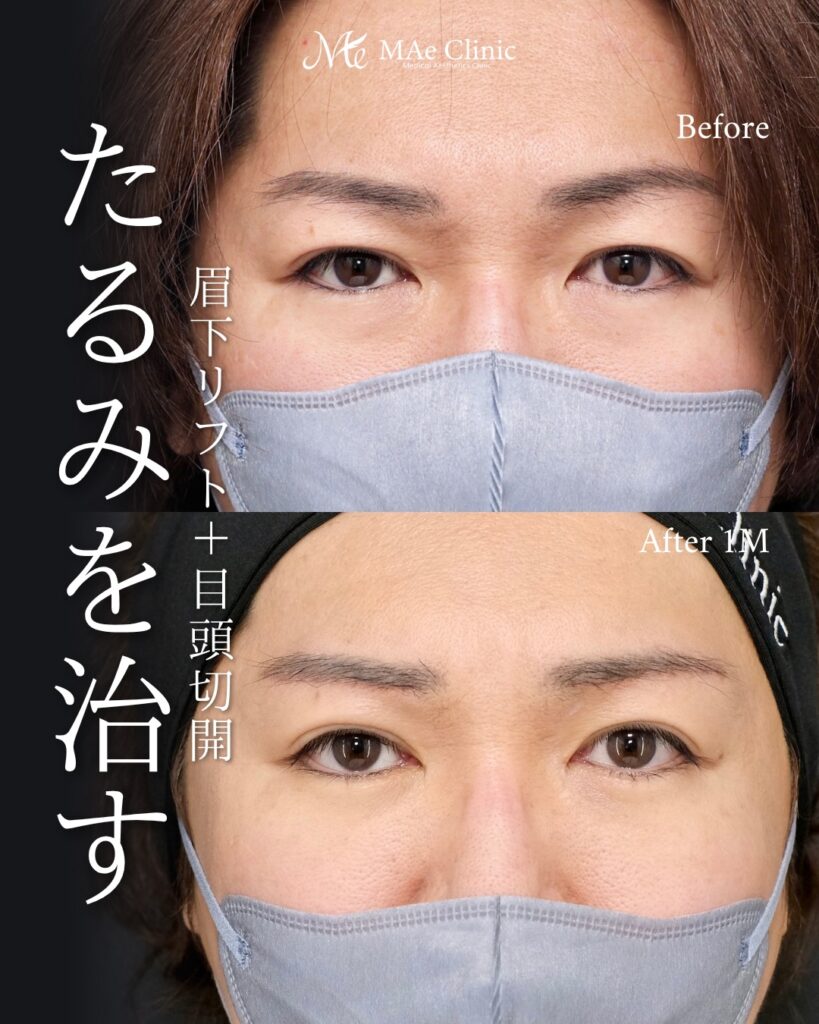 眉下リフト ROOF切除 目頭切開 裏ハムラ法 前之園健太医師症例