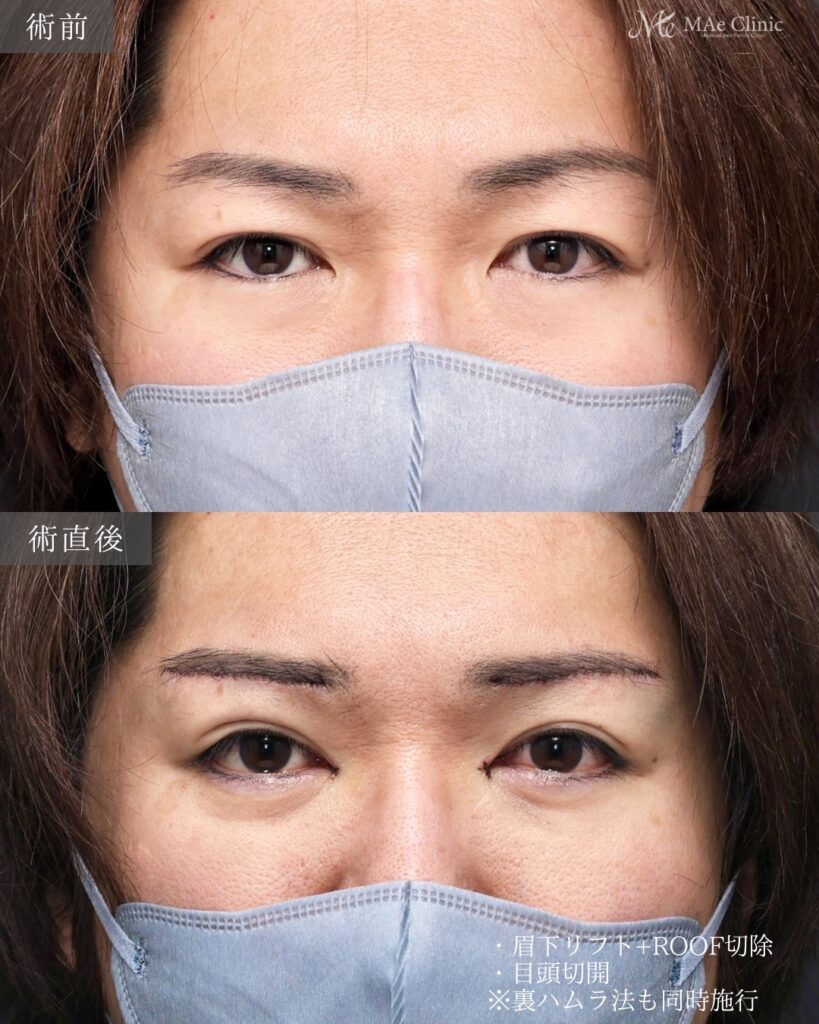 眉下リフト ROOF切除 目頭切開 裏ハムラ法 前之園健太医師症例