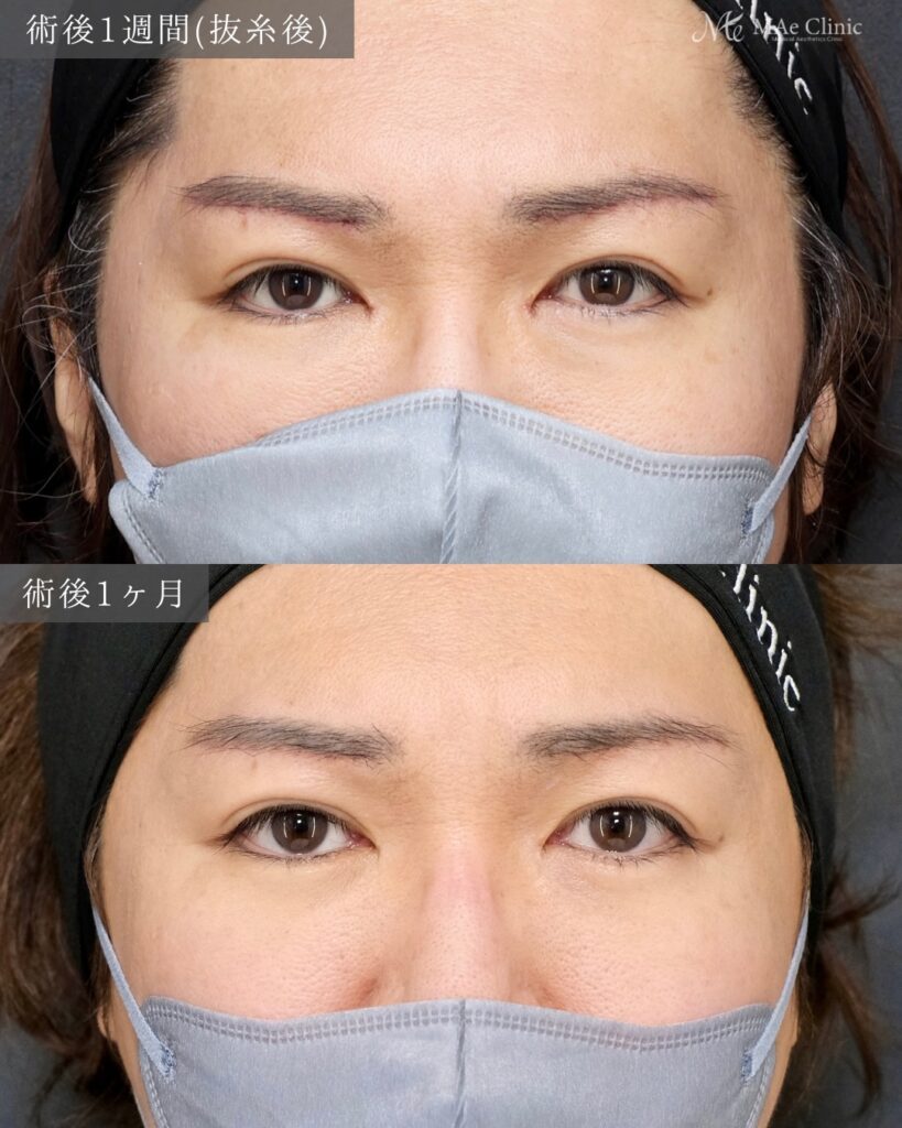 眉下リフト ROOF切除 目頭切開 裏ハムラ法 前之園健太医師症例
