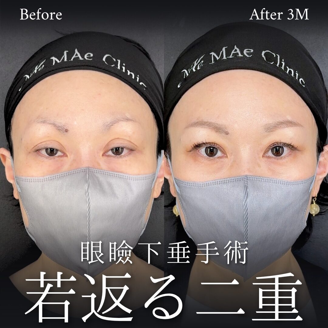まぶたの窪みと幅広二重を整えた前之園健太医師の眼瞼下垂手術術後3