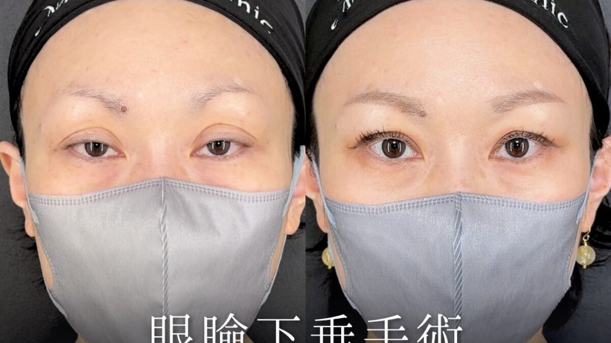 まぶたの窪みと幅広二重を整えた前之園健太医師の眼瞼下垂手術術後3