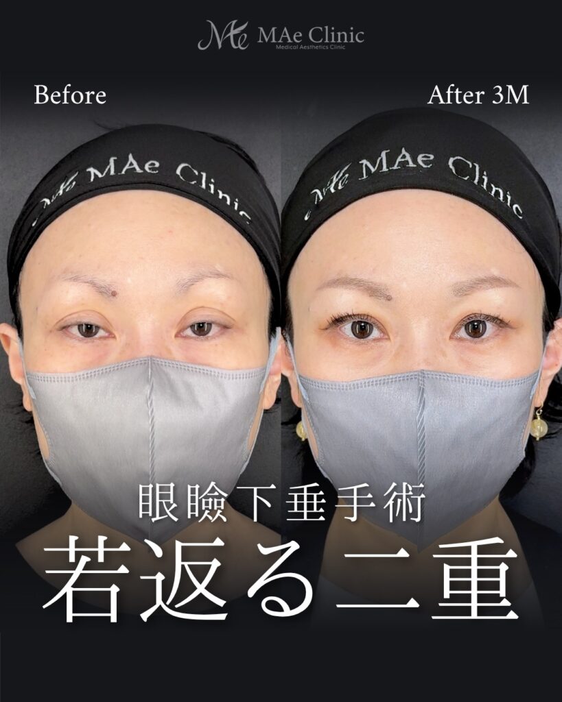 眼瞼下垂手術 前之園健太医師症例