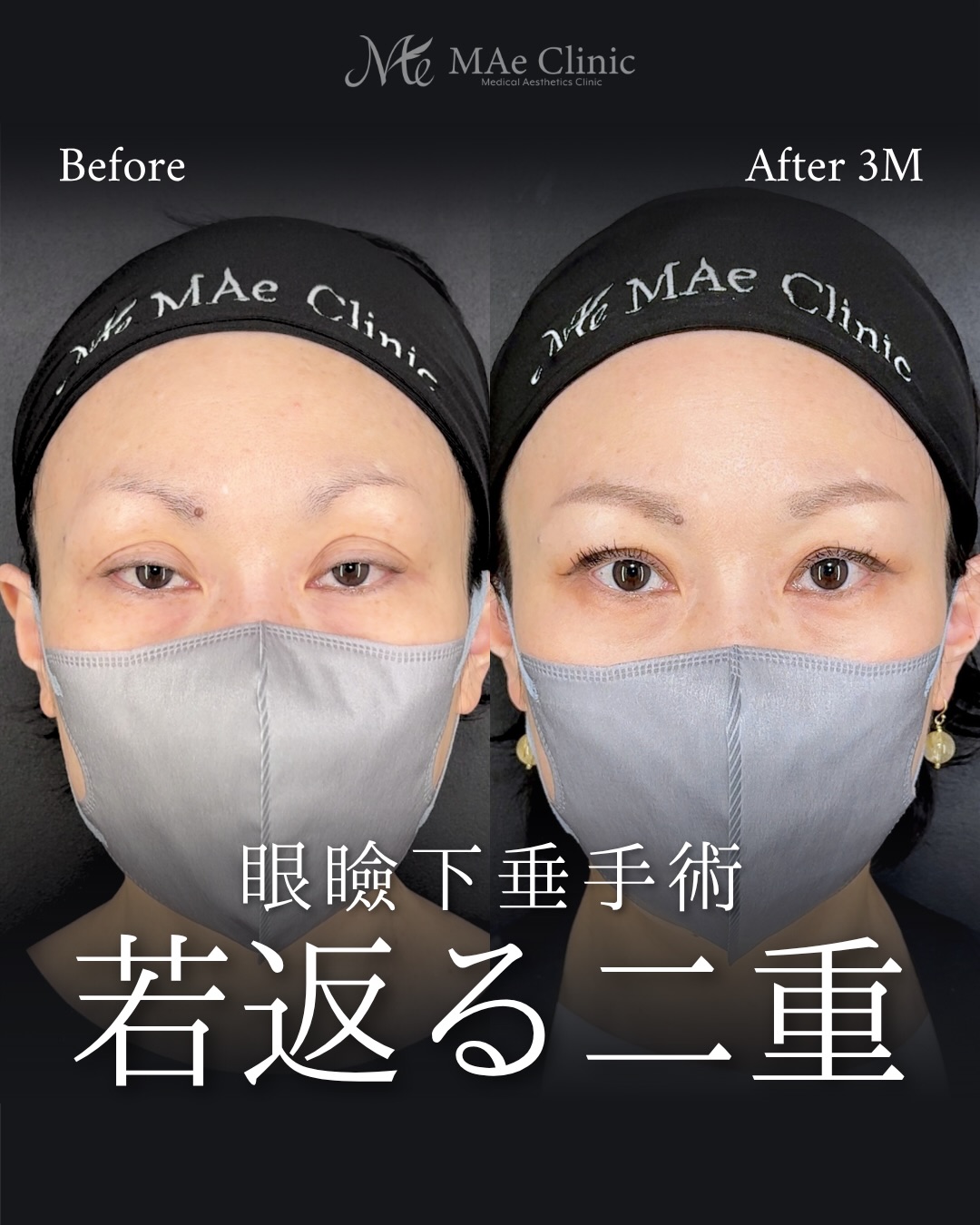 まぶたの窪みと幅広二重を整えた前之園健太医師の眼瞼下垂手術術後3