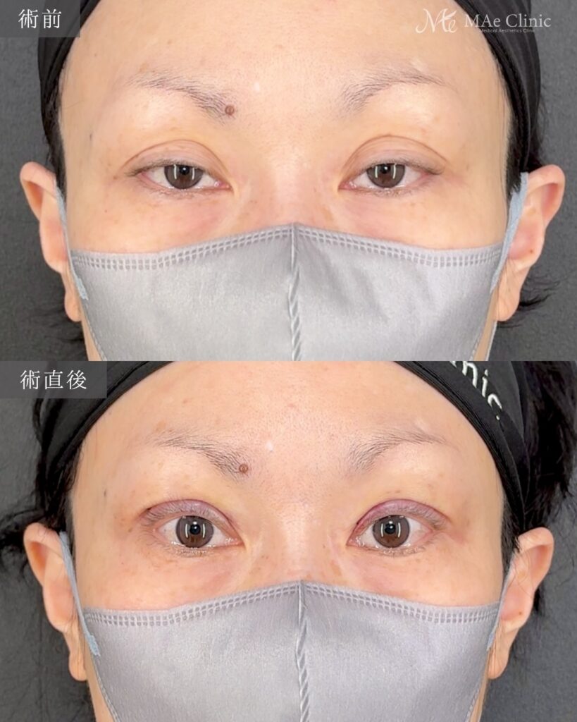 眼瞼下垂手術 前之園健太医師症例