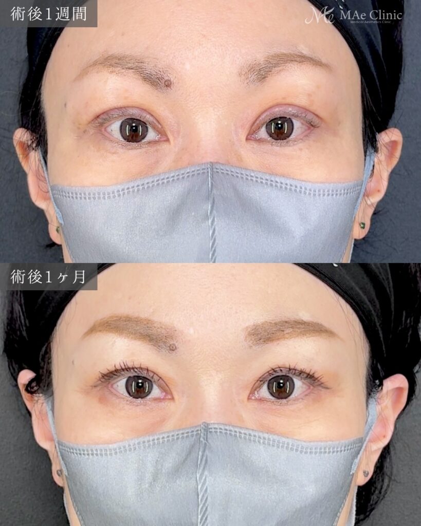 眼瞼下垂手術 前之園健太医師症例