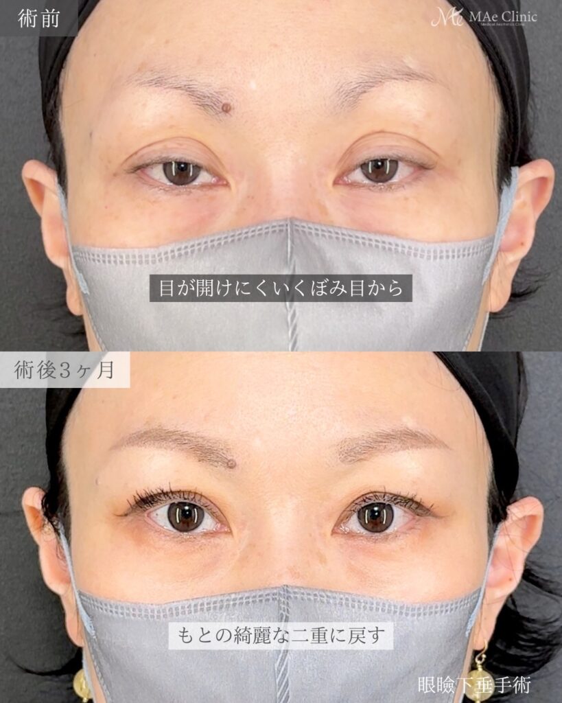 眼瞼下垂手術 前之園健太医師症例
