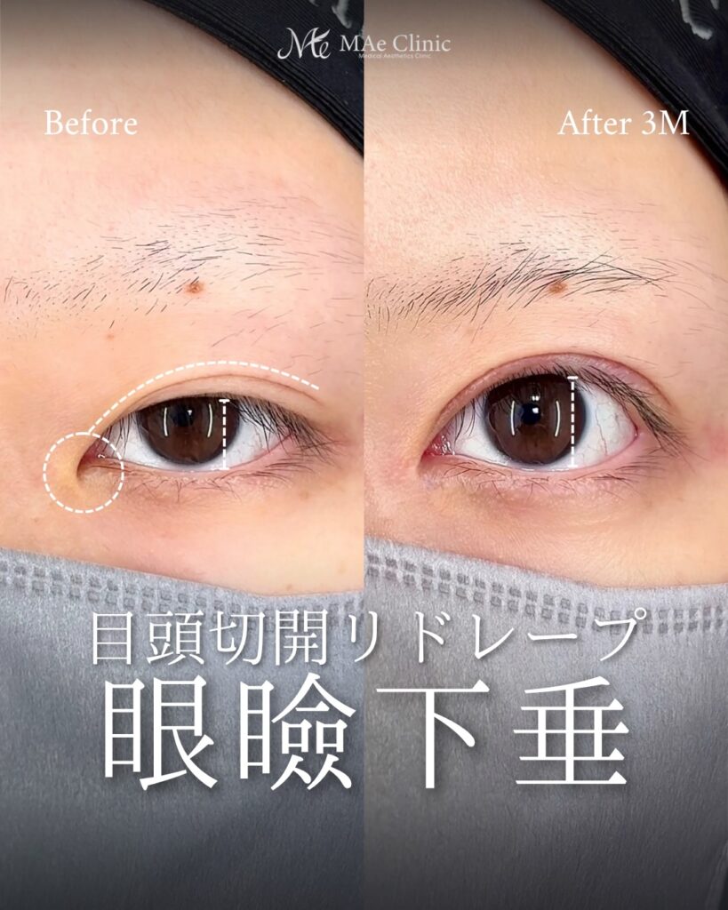 眼瞼下垂手術（二重全切開＋挙筋前転術） 目頭切開（リドレープ法） 前之園健太医師症例