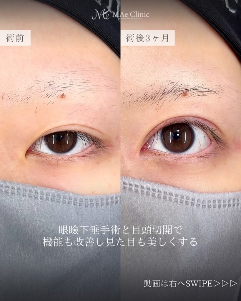 眼瞼下垂手術（二重全切開＋挙筋前転術） 目頭切開（リドレープ法） 前之園健太医師症例