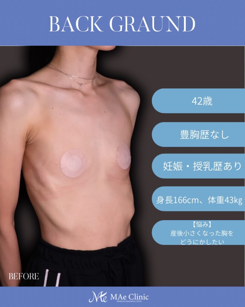 シリコンバッグ豊胸（Motiva Ergonomix2 250cc）
木下恵里沙医師症例