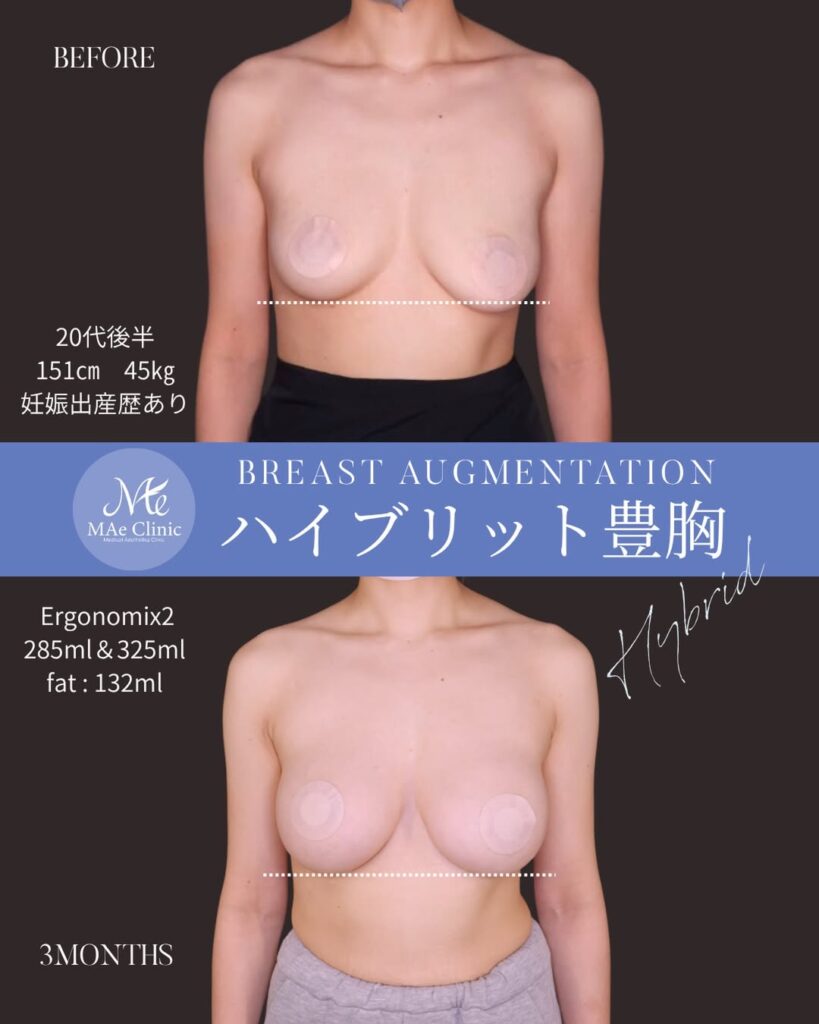 ハイブリッド豊胸（シリコンバッグ＋脂肪注入） Motiva Ergonomix2（右285ml / 左325ml） 脂肪注入（計132ml） 木下恵里沙医師症例