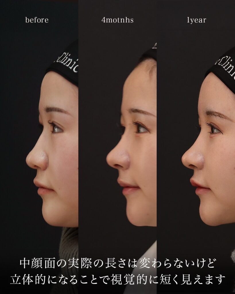 鼻中隔延長（肋軟骨） 鼻尖形成 鼻尖軟骨移植 隆鼻（肋軟骨） 猫貴族手術（肋軟骨） オトガイ形成 耳下リフト ペリカン手術 3D厚み調整 顎先軟骨移植 コンデンスリッチ脂肪注入（額・唇） 前田翔医師症例