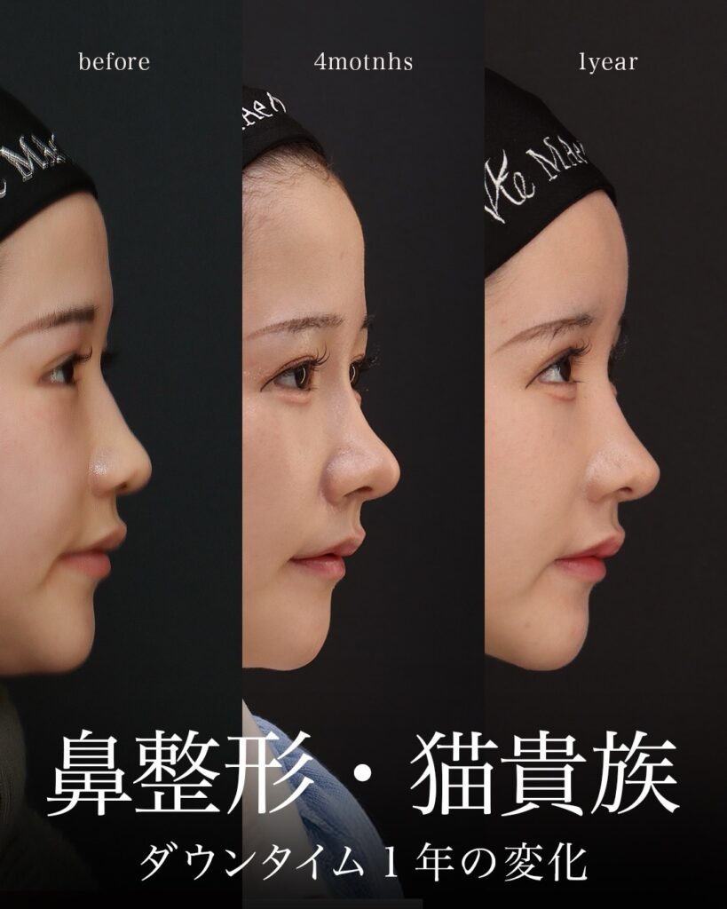 鼻中隔延長（肋軟骨）

鼻尖形成

鼻尖軟骨移植

隆鼻（肋軟骨）

猫貴族手術（肋軟骨）

オトガイ形成

耳下リフト

ペリカン手術

3D厚み調整

顎先軟骨移植

コンデンスリッチ脂肪注入（額・唇）
前田翔医師症例