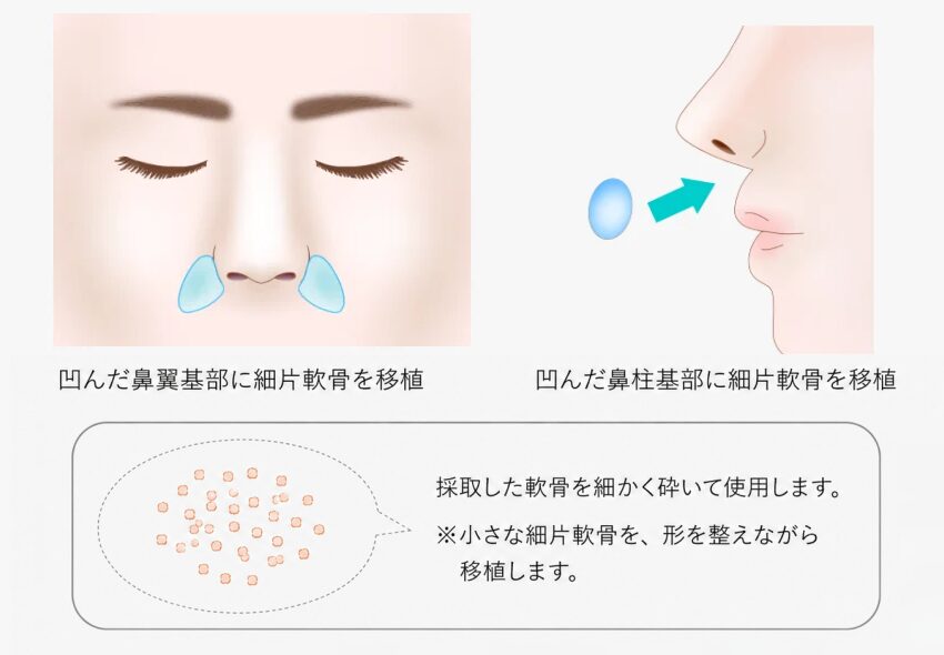 猫貴族手術 施術方法