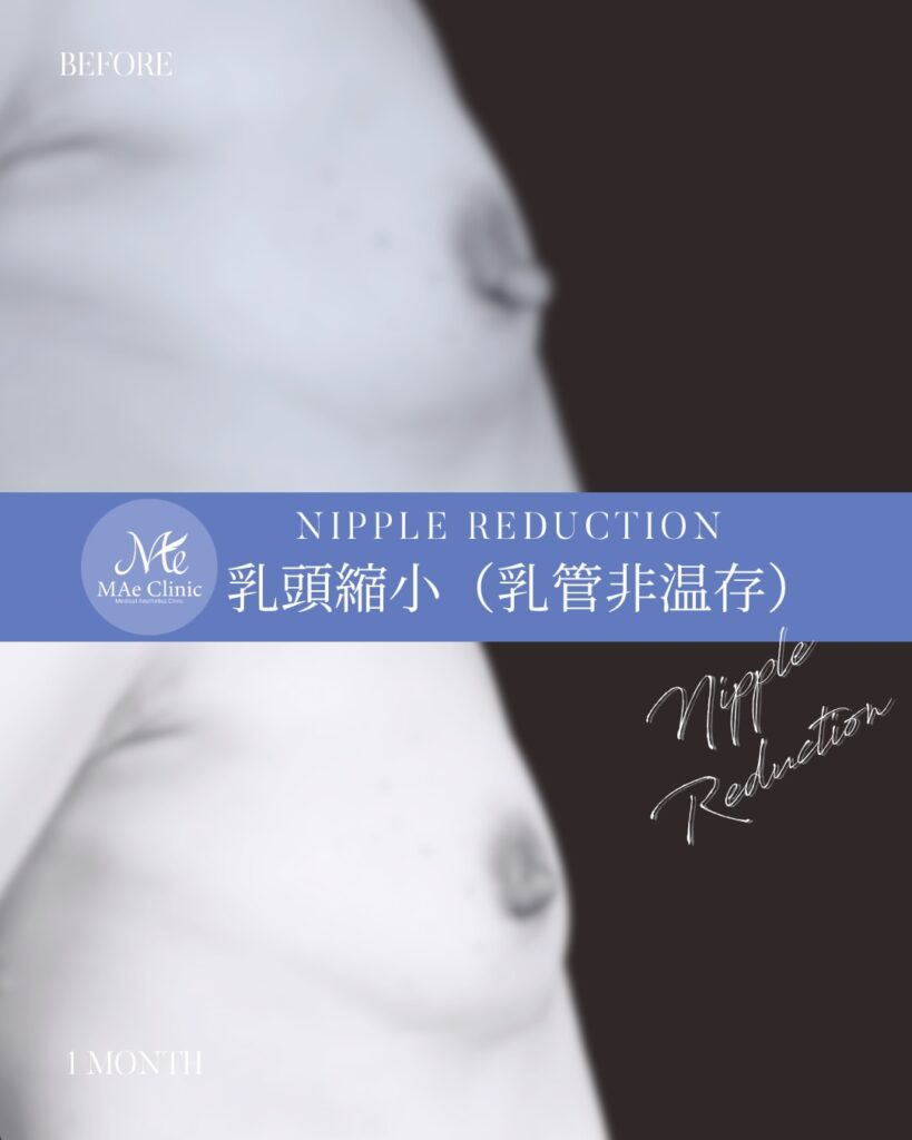 乳頭縮小術（非温存法） 木下恵里沙医師症例