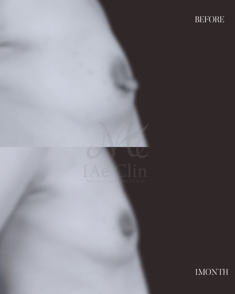 乳頭縮小術（非温存法） 木下恵里沙医師症例