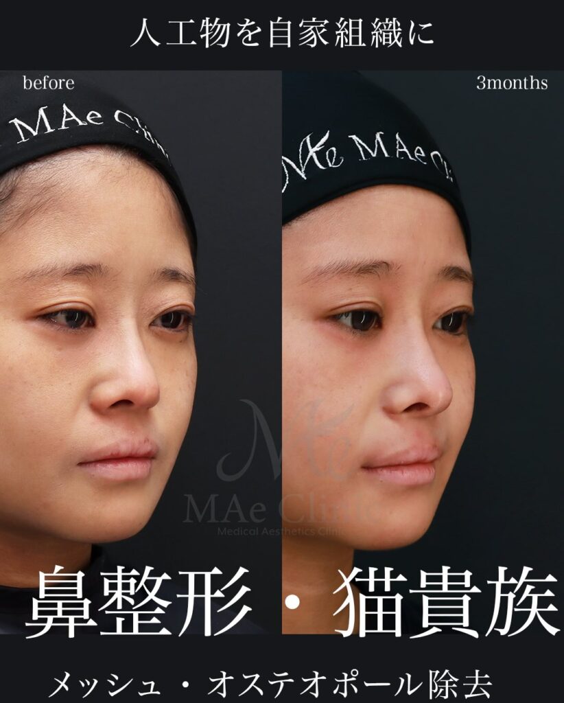 鼻中隔延長（肋軟骨） 鼻尖形成 鼻尖軟骨移植 猫貴族手術（肋軟骨・鼻翼基部および鼻柱基部移植） 望月正人医師症例