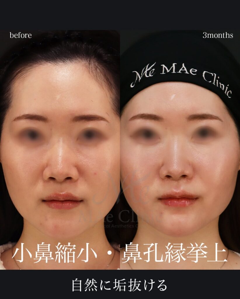 小鼻縮小術（内側法）
鼻孔縁挙上術
望月正人医師症例