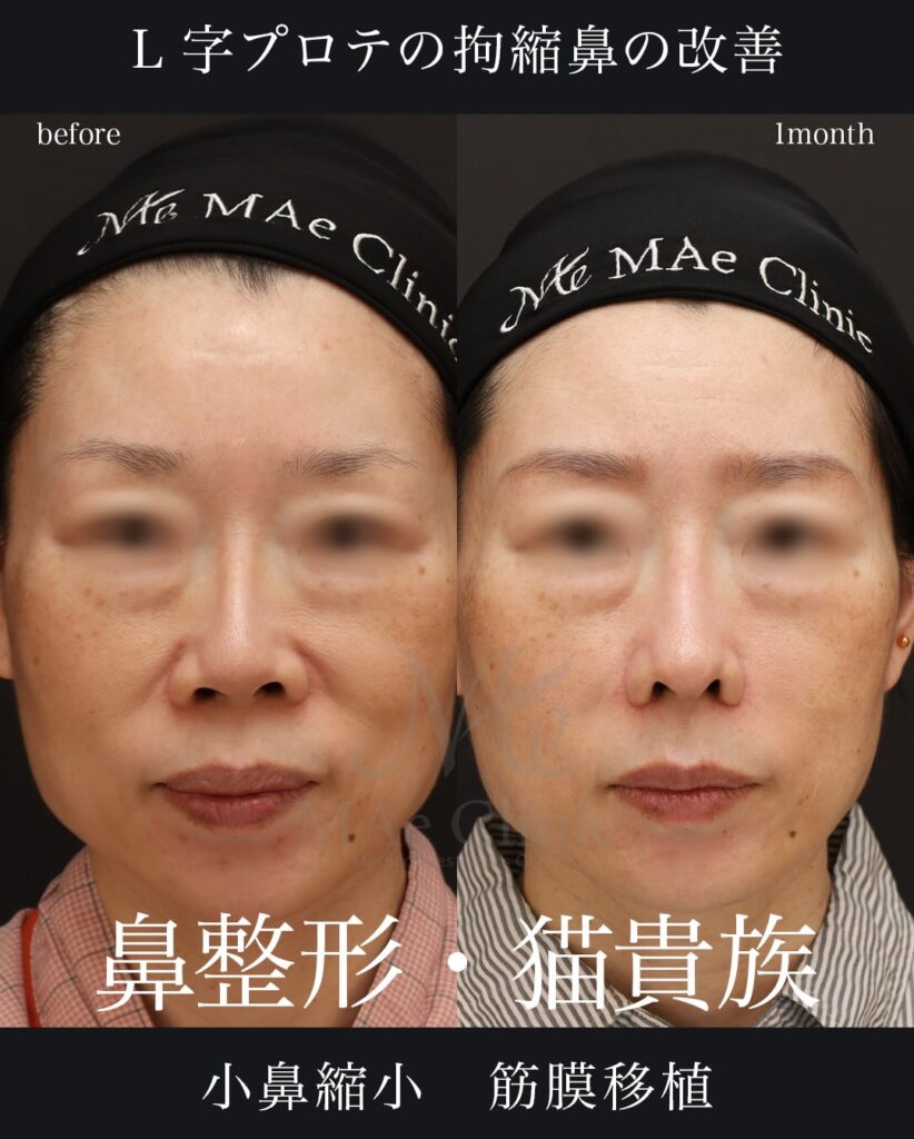 プロテーゼ抜去・I型加工再挿入 筋膜移植(腹直筋筋膜によるプロテーゼカバー) 鼻中隔延長(肋軟骨) 鼻尖形成 鼻尖軟骨移植 猫貴族手術 望月正人医師症例