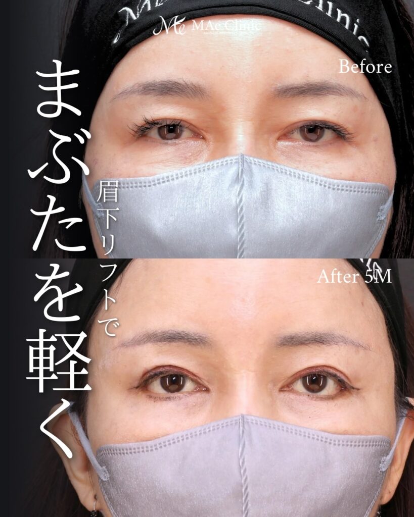 眉下リフト 前之園健太医師症例