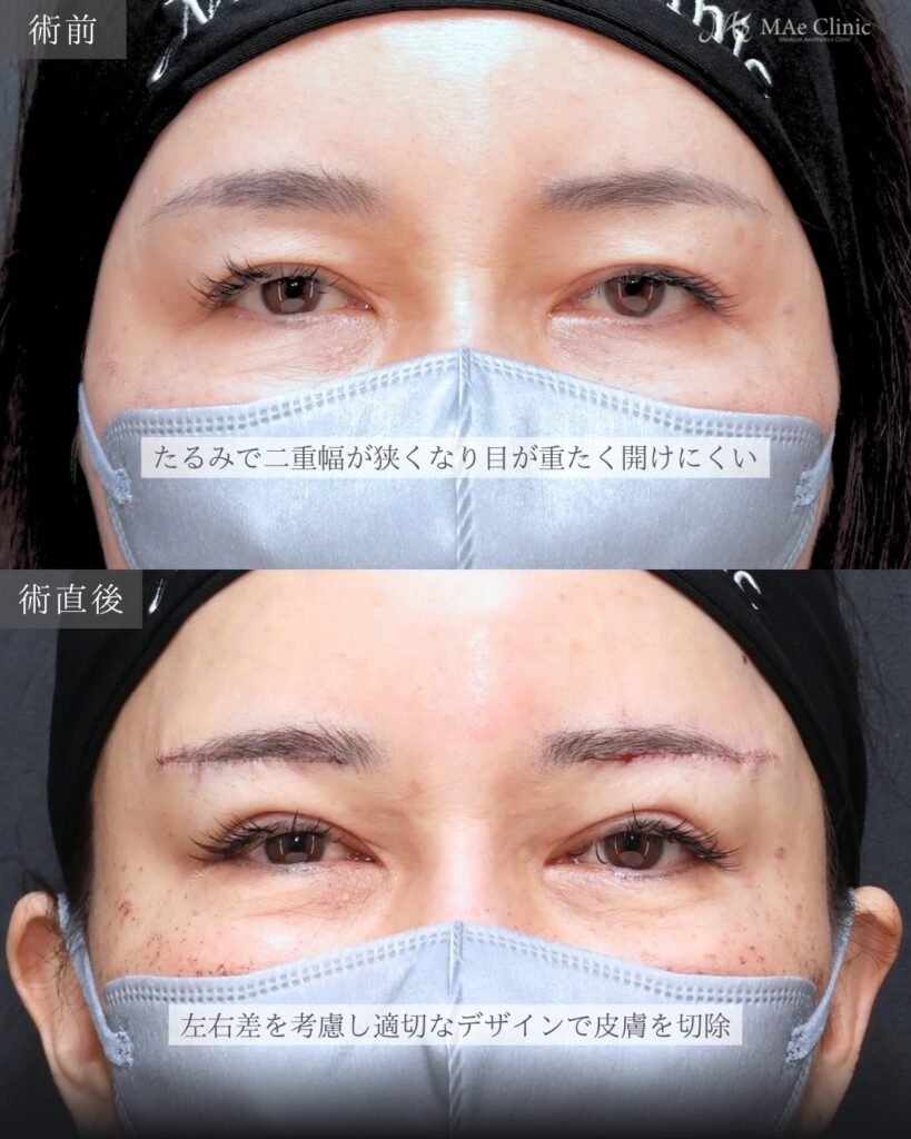 眉下リフト 前之園健太医師症例