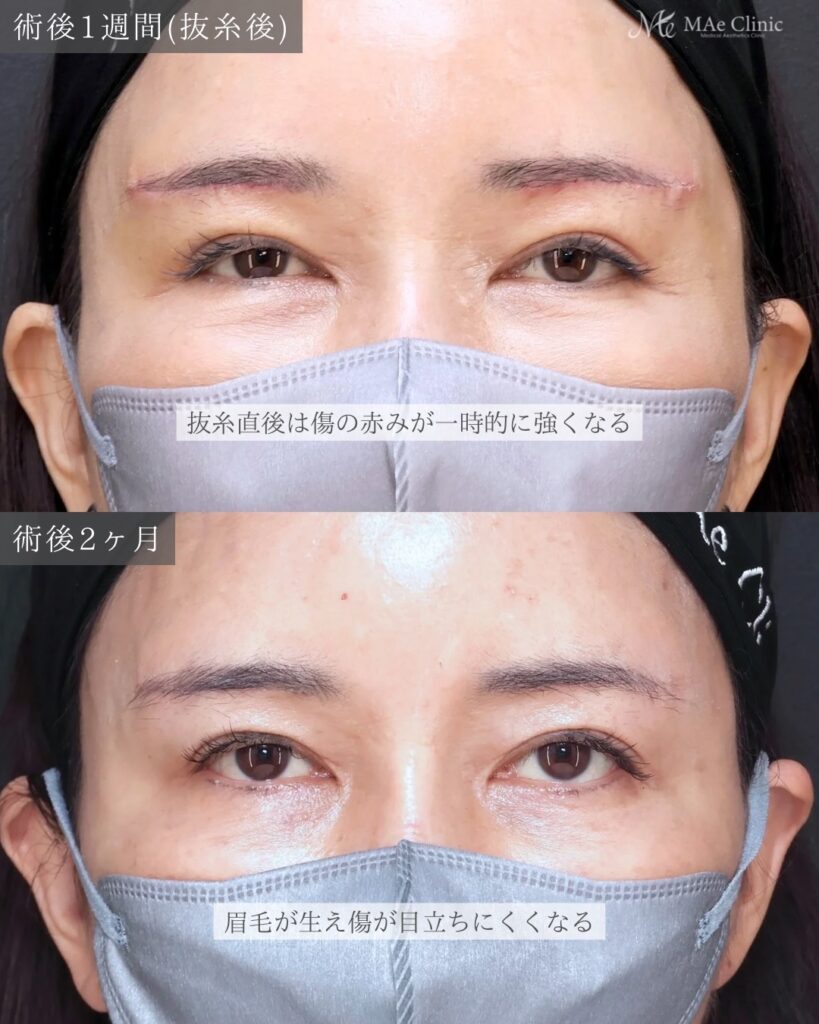 眉下リフト 前之園健太医師症例