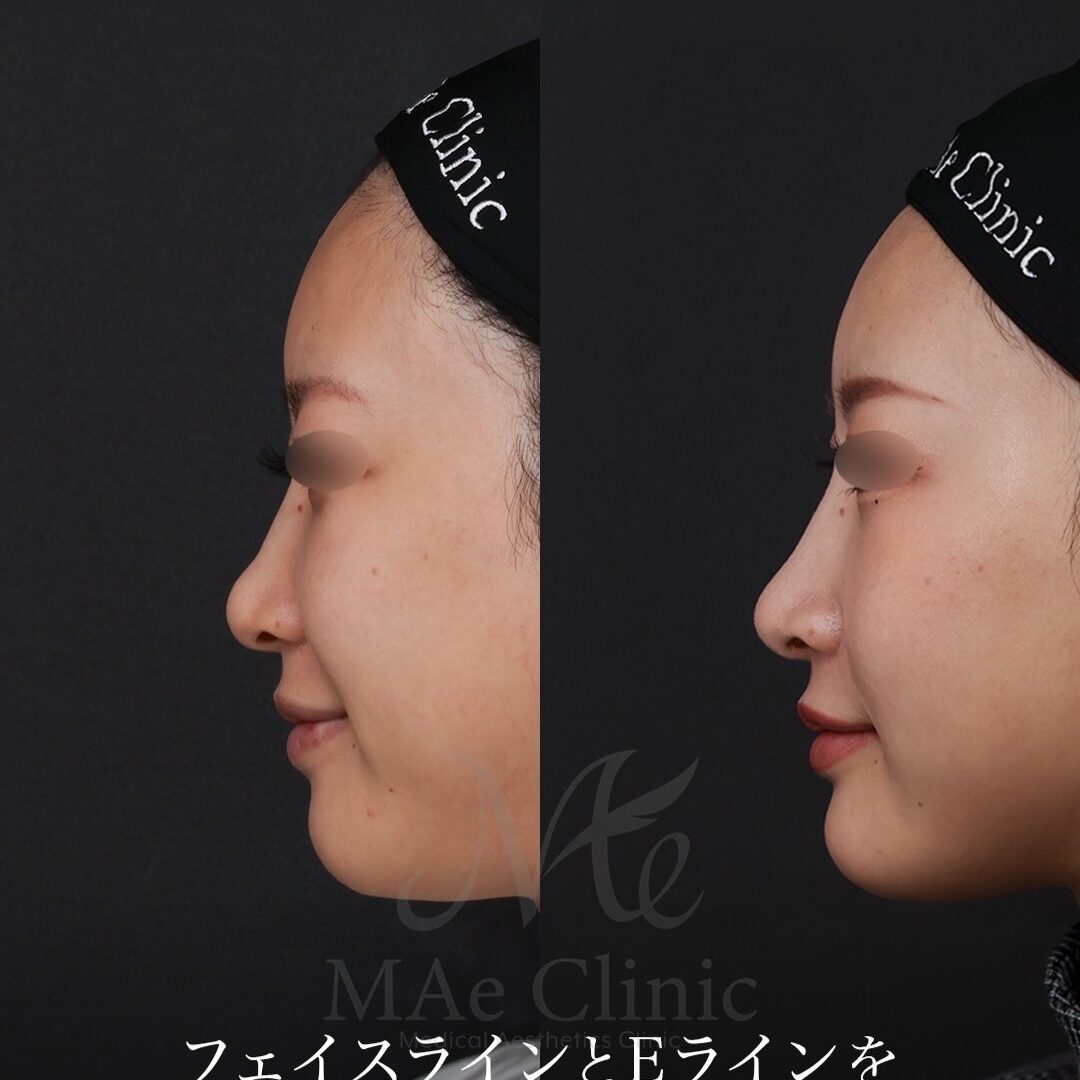 肋軟骨を用いた鼻顎のトータルアプローチで自然なEラインを構築した