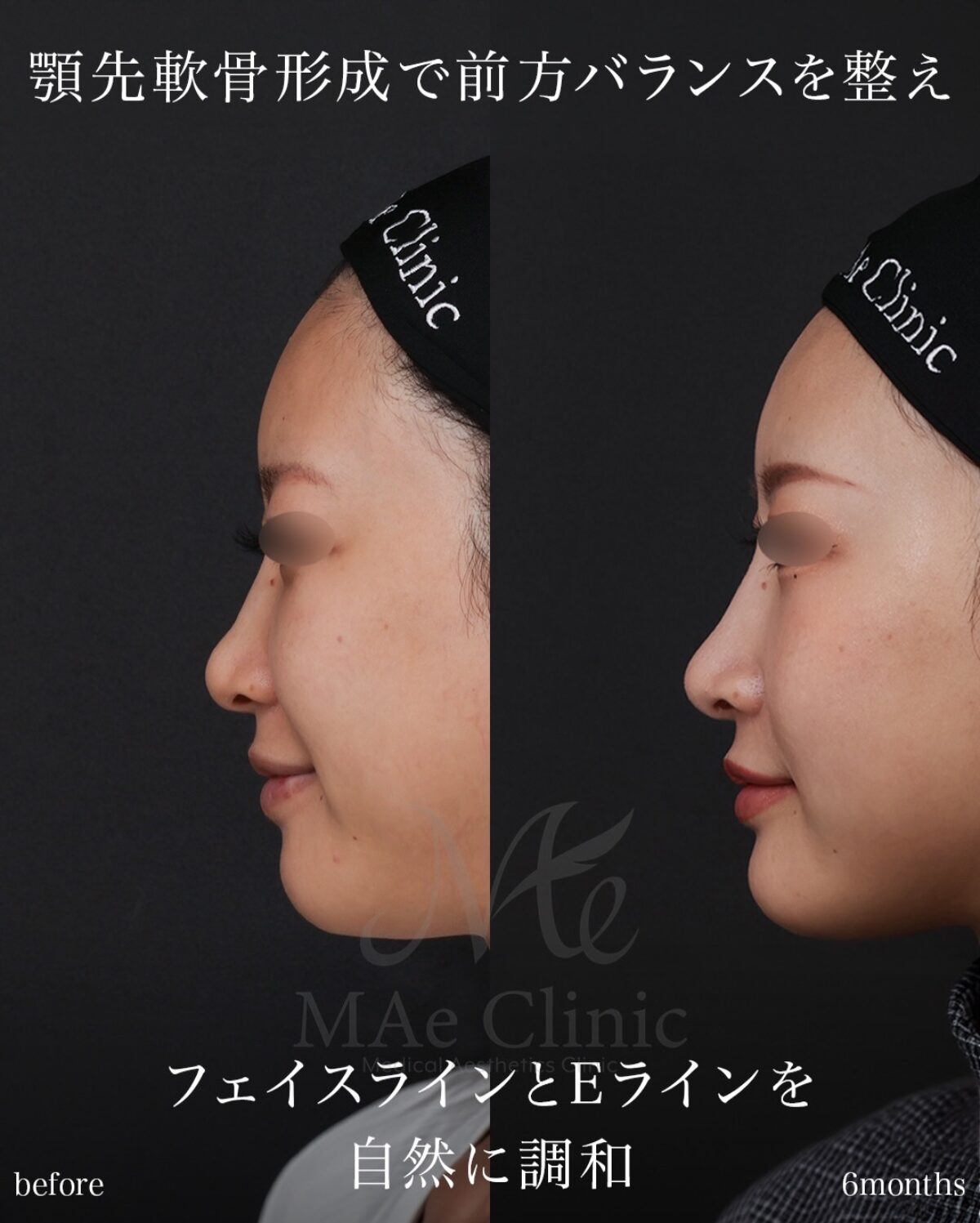 肋軟骨を用いた鼻顎のトータルアプローチで自然なEラインを構築した