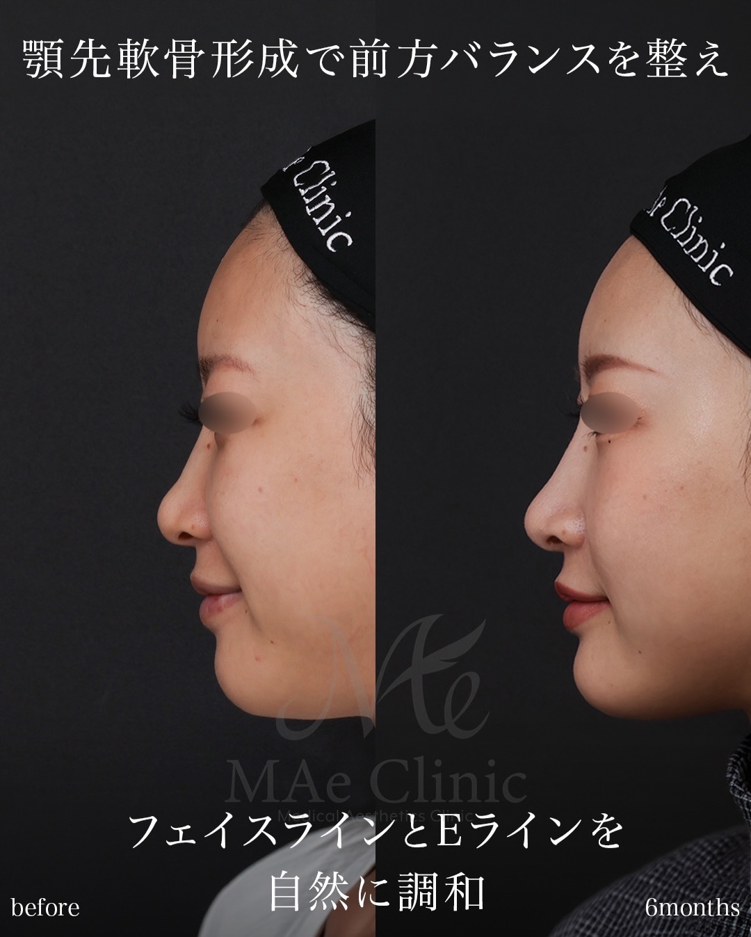 肋軟骨を用いた鼻顎のトータルアプローチで自然なEラインを構築した