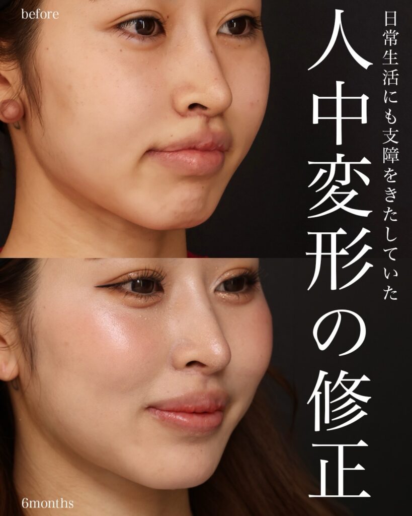裏人中短縮術（他院修正） 3D厚み調整術 口唇拡大術（上唇） 前田翔医師症例