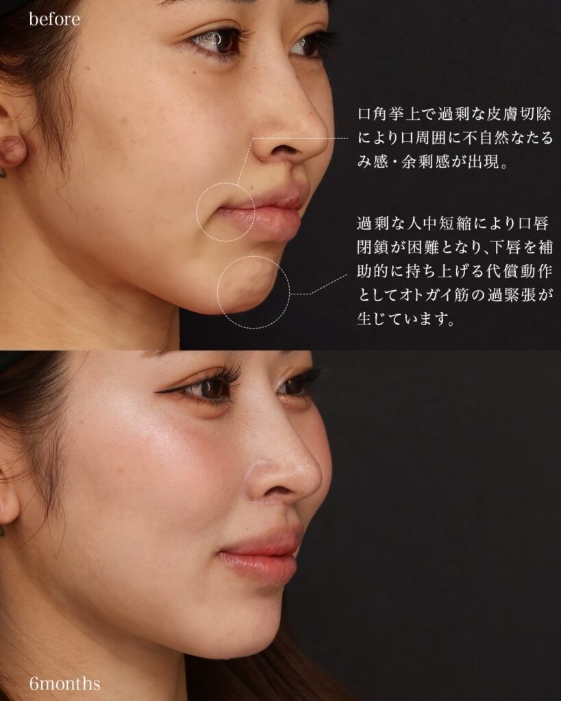 裏人中短縮術(他院修正) 3D厚み調整術 口唇拡大術(上唇) 前田翔医師症例