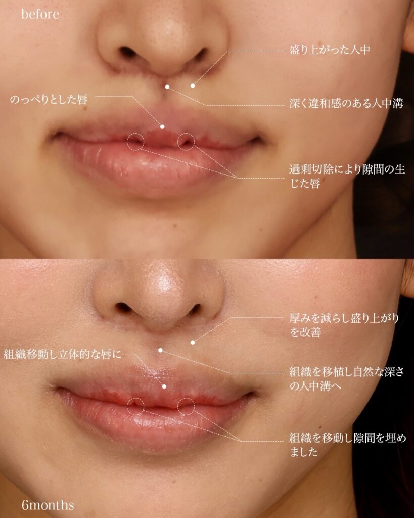 裏人中短縮術(他院修正) 3D厚み調整術 口唇拡大術(上唇) 前田翔医師症例