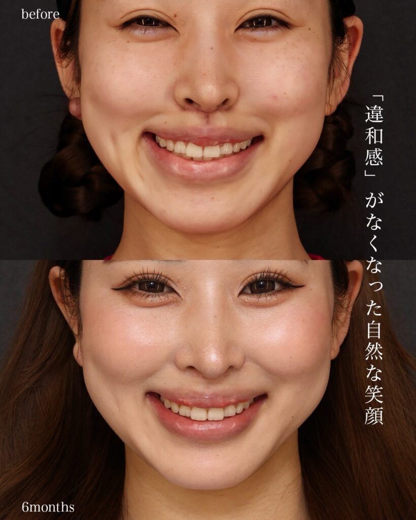 裏人中短縮術(他院修正) 3D厚み調整術 口唇拡大術(上唇) 前田翔医師症例