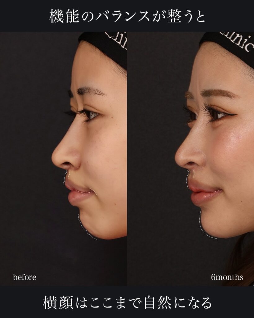 裏人中短縮術(他院修正) 3D厚み調整術 口唇拡大術(上唇) 前田翔医師症例