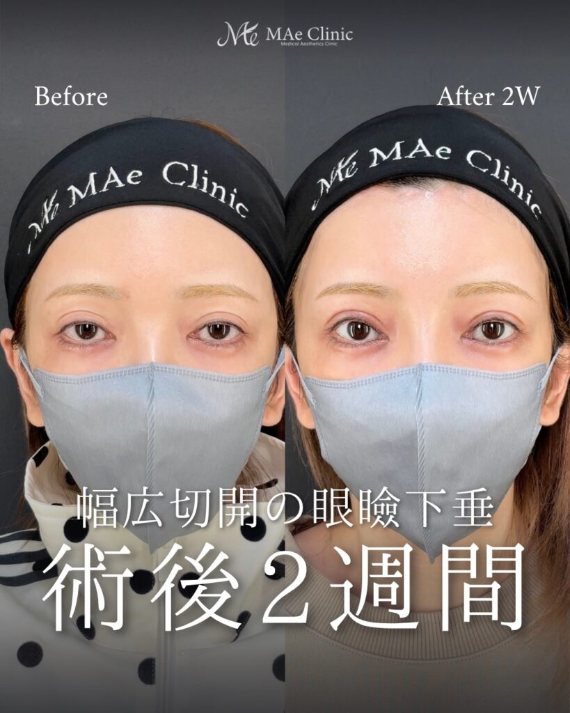 眼瞼下垂手術 前之園健太医師症例