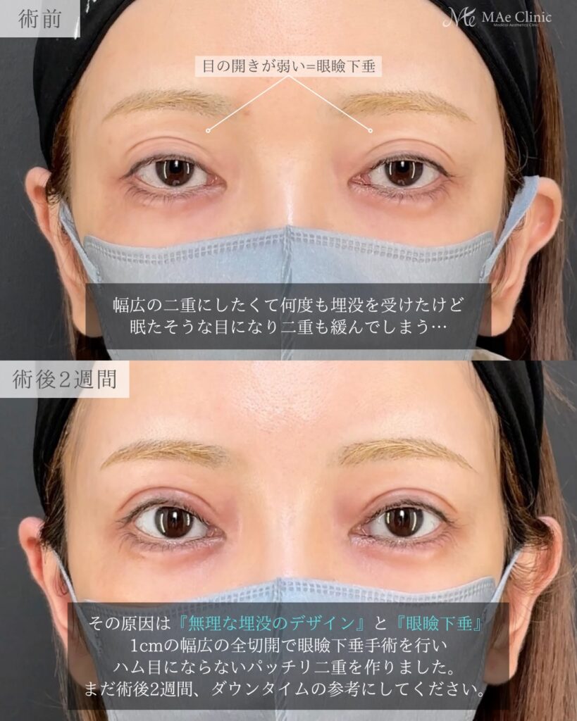 眼瞼下垂手術 前之園健太医師症例