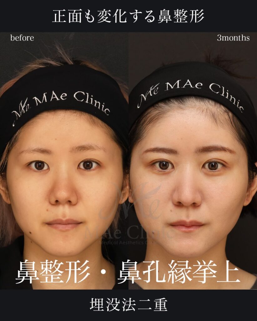鼻中隔延長（肋軟骨） 鼻尖形成 鼻尖軟骨移植 二重埋没法 望月正人医師症例