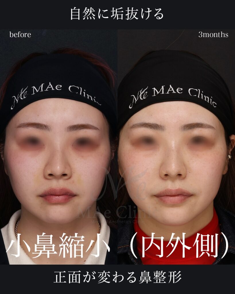 鼻翼縮小（内側＋外側法）症例